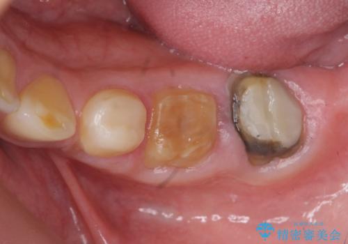 歯周外科で達成する、安定したクラウン周囲の歯肉環境の治療前