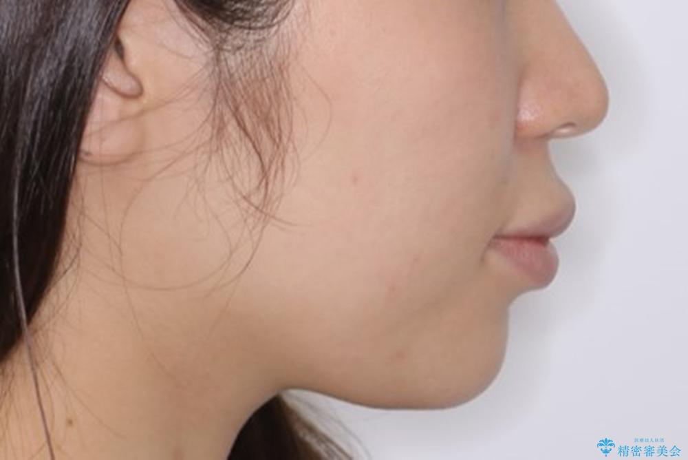 部分矯正とインビザラインを組み合わせて短期間での矯正治療の治療前(顔貌)