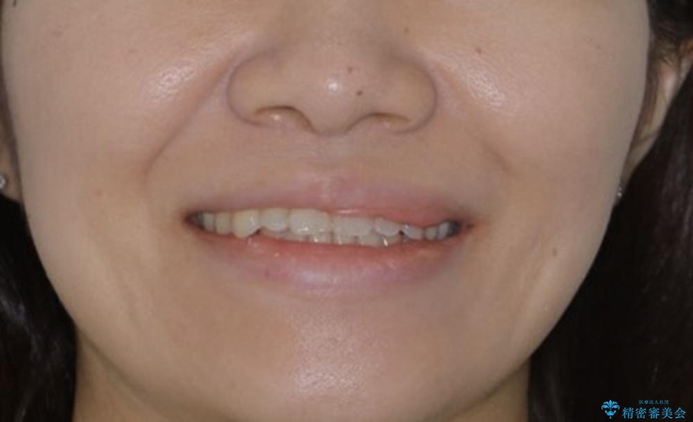 インビザラインで前歯の中心をお顔の中心に合わせるの治療後（顔貌）