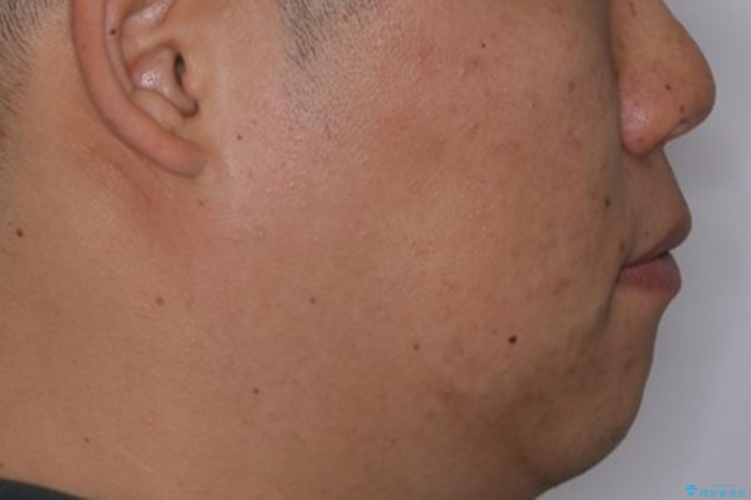 光加速矯正装置(オルソパルス)を用いた短期間での矯正治療の治療後(顔貌)