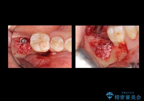 奥歯の歯ぐきからウミが出る 抜歯してインプラントへの治療中