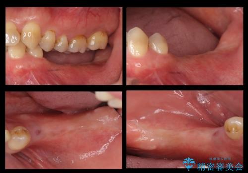 奥歯のインプラント 大人になって残っていた乳歯がダメになったの治療中