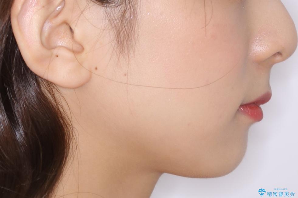 動きづらい前歯のねじれもマウスピース(インビザライン)で改善の治療前(顔貌)