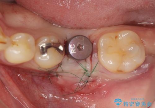 銀歯下の虫歯再発 インプラントによる機能回復の治療中