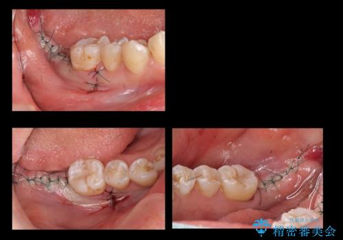 奥歯の歯ぐきからウミが出る 抜歯してインプラントへの治療中