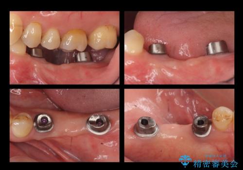 奥歯のインプラント 大人になって残っていた乳歯がダメになったの治療中