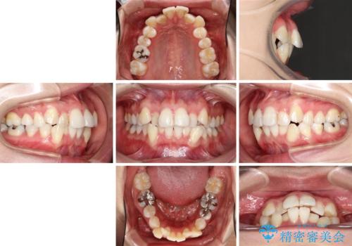 目立たないハーフリンガル矯正 抜歯矯正で口元を改善の治療前
