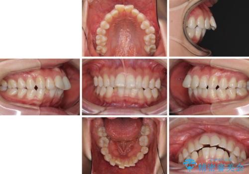 インビザラインが続けられない ワイヤー装置による抜歯矯正の治療前