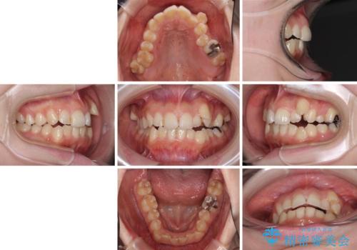 顕著な八重歯をインビザラインで治せるところまで改善の治療前