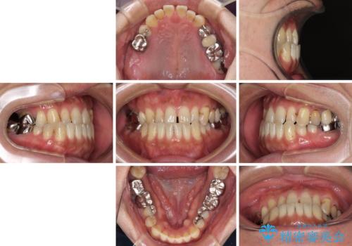 前歯の反対咬合をワイヤー矯正で改善して噛みやすくの治療前