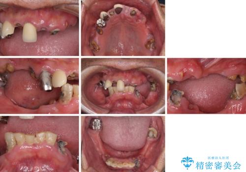 どこで咬んでいいのか分からない インプラント・オーバーデンチャーによる補綴治療の治療前