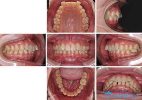 下顎2前歯の欠損 インビザラインによる抜歯矯正の治療前