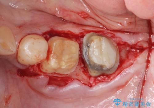 歯周外科で達成する、安定したクラウン周囲の歯肉環境の治療中