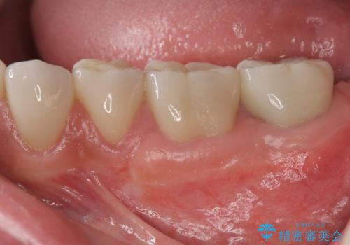 歯周外科で達成する、安定したクラウン周囲の歯肉環境の症例 治療後