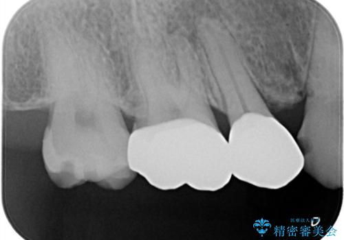 【メタルフリー】オールセラミッククラウンの治療後
