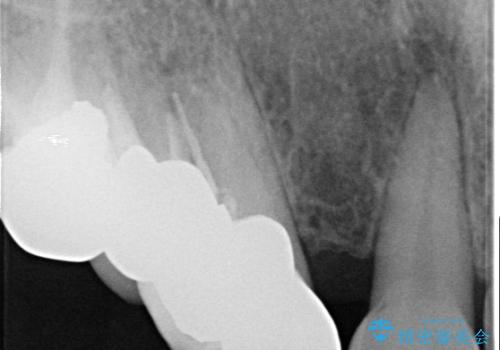 ラミネートベニアがかけた。オールセラミッククラウンで修復の治療後