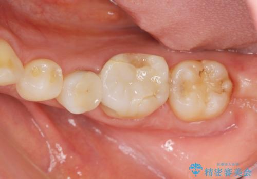 検診で判明した虫歯の再発の症例 治療前