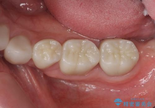 歯周外科で達成する、安定したクラウン周囲の歯肉環境の治療後