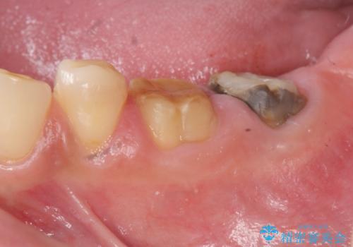 歯周外科で達成する、安定したクラウン周囲の歯肉環境の治療前