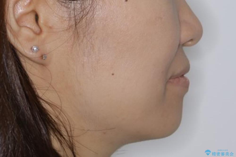 インビザラインで前歯の中心をお顔の中心に合わせるの治療後(顔貌)