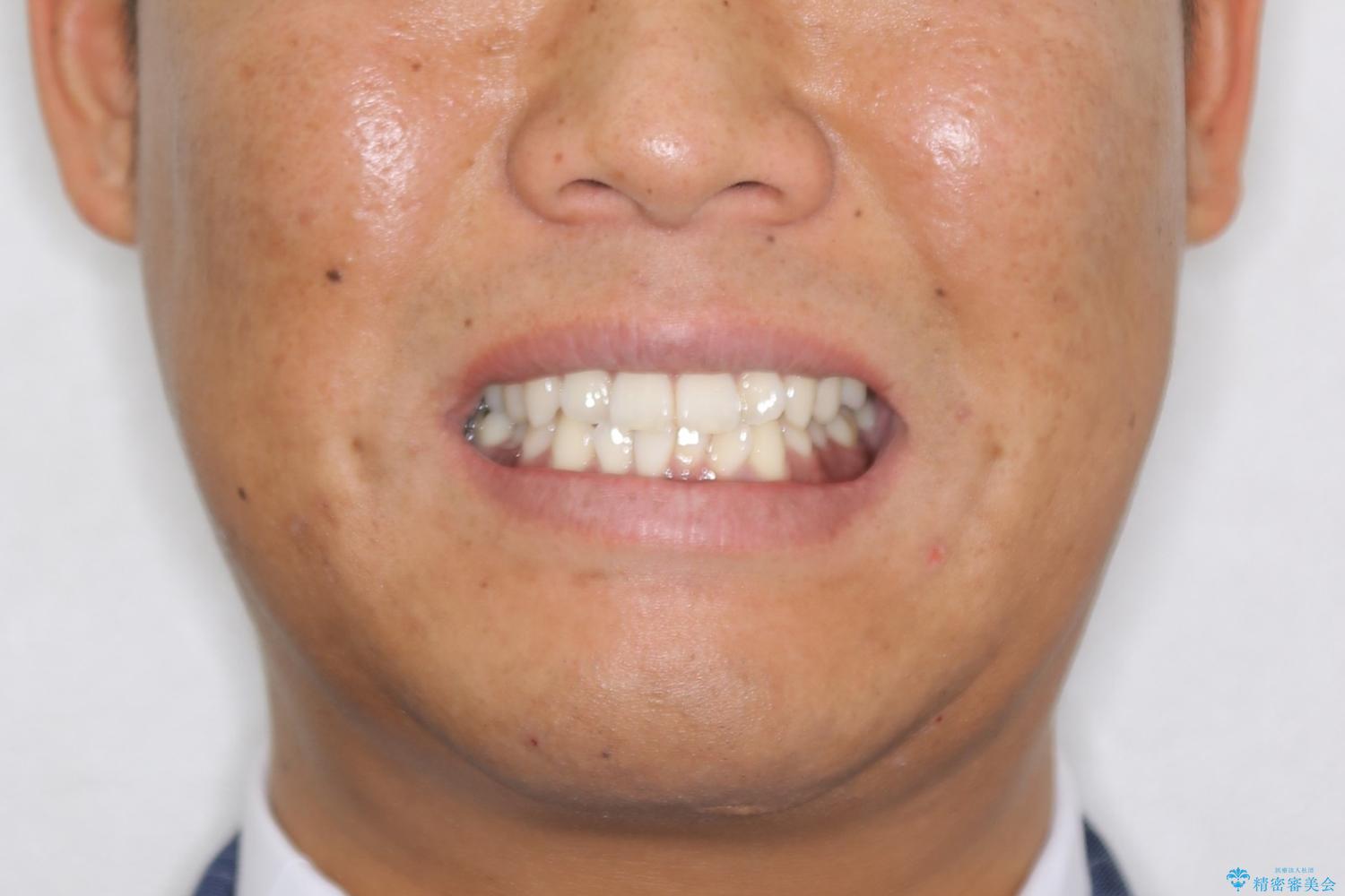 光加速矯正装置(オルソパルス)を用いた短期間での矯正治療の治療前(顔貌)