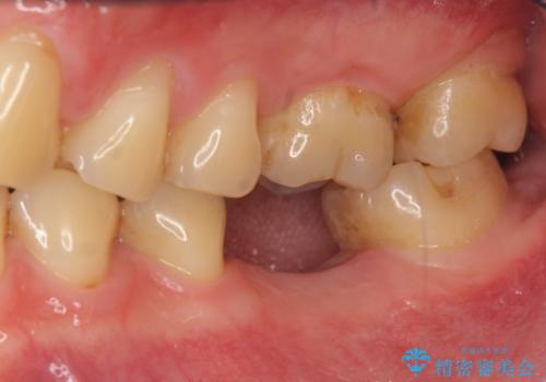 銀歯下の虫歯再発 インプラントによる機能回復の治療中