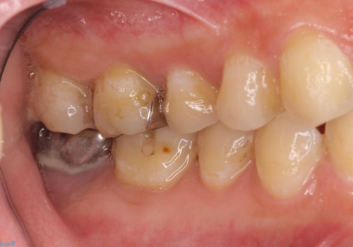 奥歯の歯ぐきからウミが出る　抜歯してインプラントへ