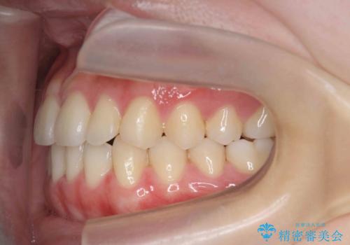 ガタつきの改善 マウスピース矯正治療の治療後
