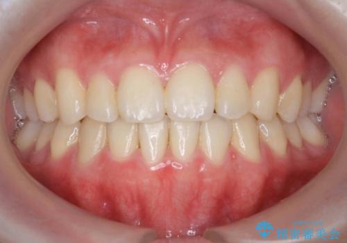 ガタつきの改善 マウスピース矯正治療の症例 治療後