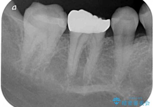 割れてしまったセラミッククラウン 強化セラミッククラウンの補綴治療の治療前