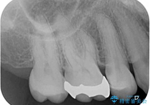 奥歯がしみる むし歯と知覚過敏の補綴治療 の治療前