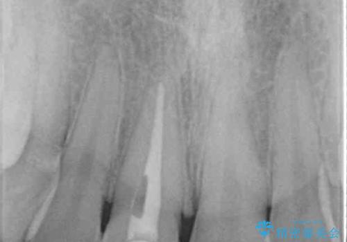 茶色になった前歯 オーダーメイドタイプのオールセラミッククラウンの治療前