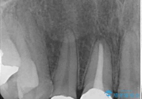 前歯の虫歯 つぎはぎの歯をセラミックにの治療前