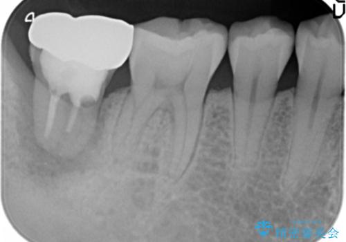 奥歯の歯ぐきからウミが出る　抜歯してインプラントへの治療前