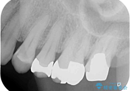 奥歯が外れた ゴールドクラウンによる補綴治療の治療前