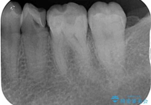 検診で判明した虫歯の再発の治療前