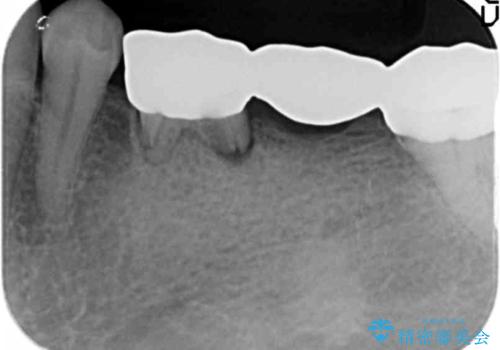 奥歯のインプラント 大人になって残っていた乳歯がダメになったの治療前
