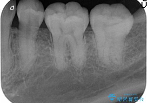 奥歯が黒い セラミッククラウンで綺麗に 30代女性の治療前