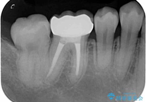 30代女性 前歯のがたつきの治療後