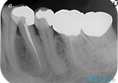 虫歯と歯並びを治したい 50代女性の治療前