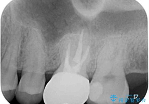 耳鼻科で指摘されたむし歯 根管治療とセラミッククラウンの治療後