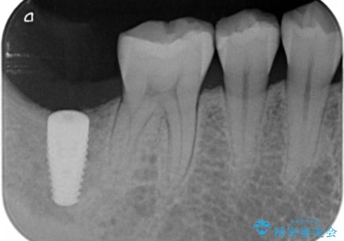 奥歯の歯ぐきからウミが出る 抜歯してインプラントへの治療中