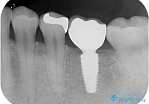 銀歯下の虫歯再発 インプラントによる機能回復