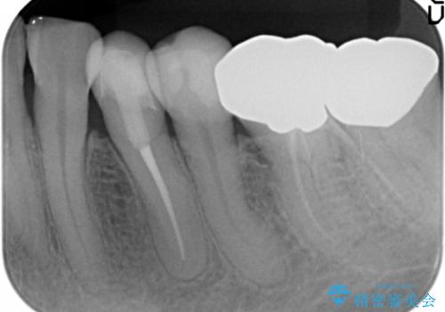 虫歯と歯並びを治したい 50代女性の治療後