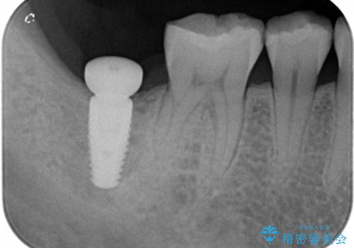 奥歯の歯ぐきからウミが出る 抜歯してインプラントへの治療中