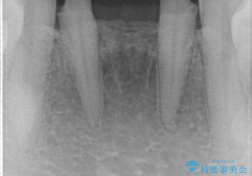 下の前歯のブリッジ 保険治療のやり替えの治療中