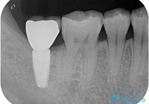 奥歯の歯ぐきからウミが出る　抜歯してインプラントへの治療後