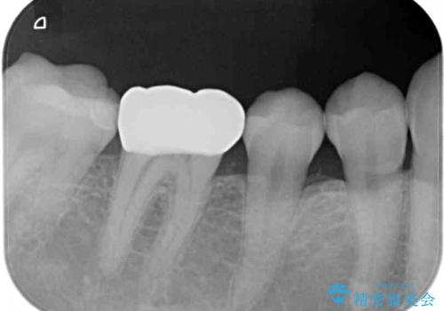割れてしまったセラミッククラウン 強化セラミッククラウンの補綴治療の治療後
