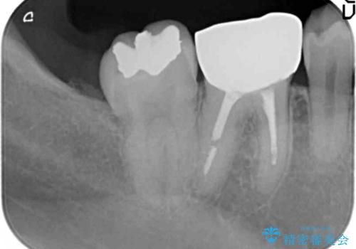 30代女性 前歯のがたつきの治療前