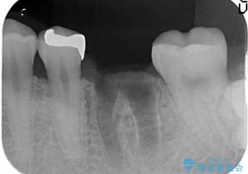 銀歯下の虫歯再発 インプラントによる機能回復の治療前